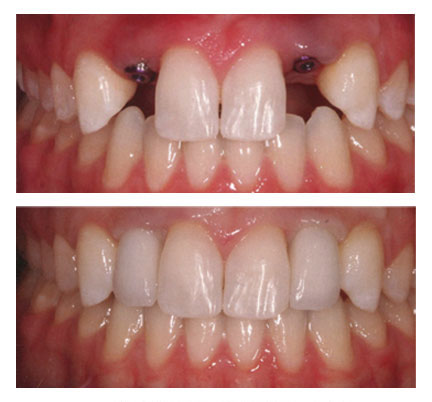 Before and after pictures of a single dental implant restoration
