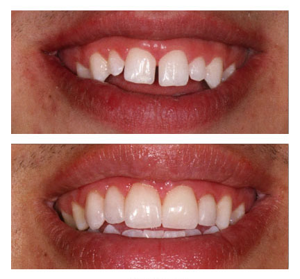 Before and after pictures of a dental veneers patient