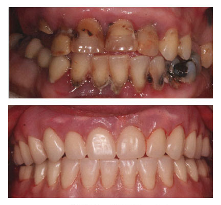 Before and after pictures of a patient with immediate dentures