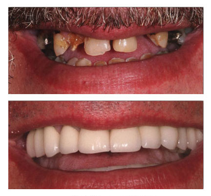 Before and after pictures of a dental patient with a crown and bridge