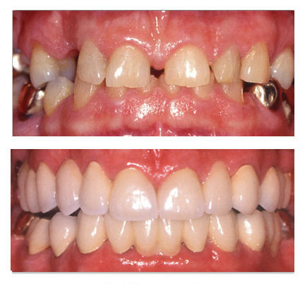 Before and after picture of a crown and bridge case