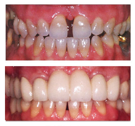 Before and after picture of a dental crown and bridge case