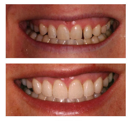 Before and fter pictures of a patient with dental veneers