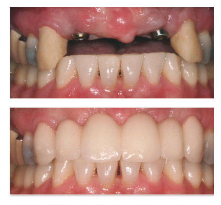 Before and after picture of a dental patient replacing multiple teeth with dental implants