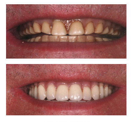 Before and after picture of a patient with dentures