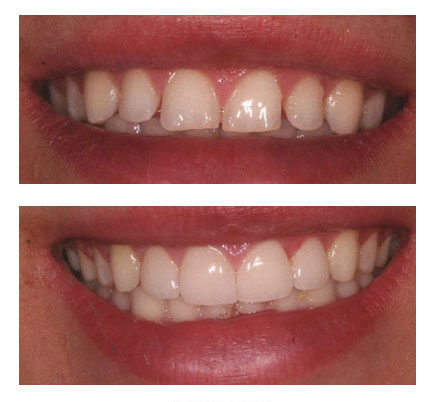 Cosmetic dentistry before and fter pictures of a patient with dental veneers
