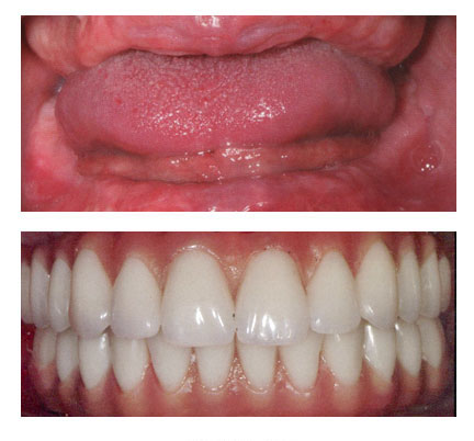 Before and after picture of a patient with dental implants